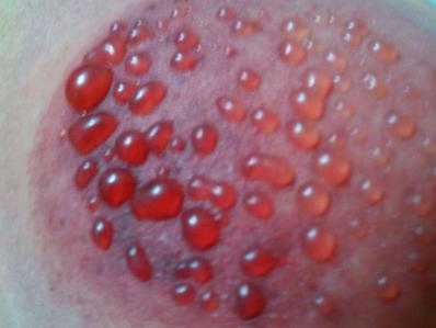 拔火罐要注意些什么？医生说：避免这6个误区和10个注意事项