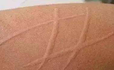 娃身上出了荨麻疹怎么办,娃儿有皮疹怎么止痒