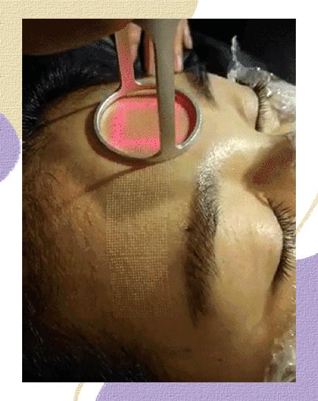 大痘印适合做什么医美,医美做什么可以去除痘坑