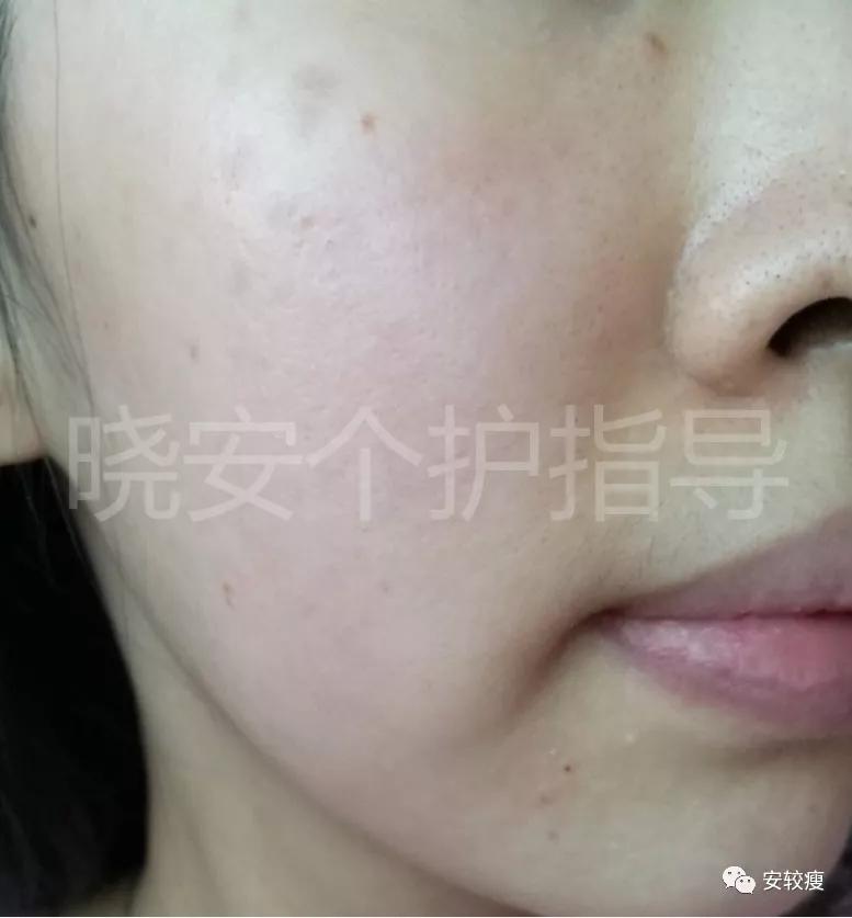 皮炎疹子干燥泛红,秋冬皮肤泛红发烫