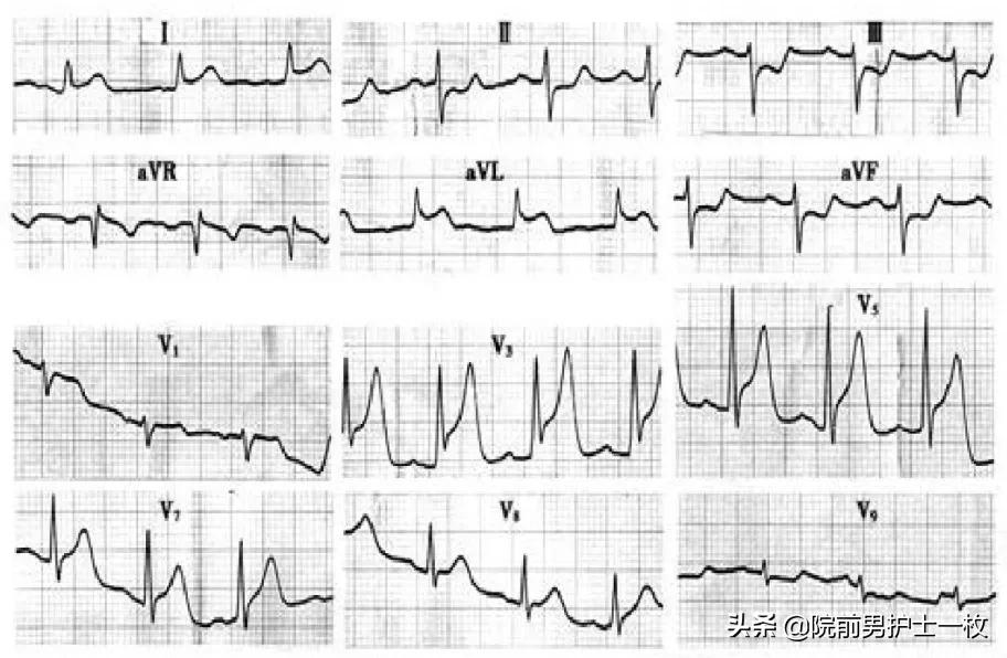 急性心梗的紧急处理视频,一旦发现急性心梗如何救