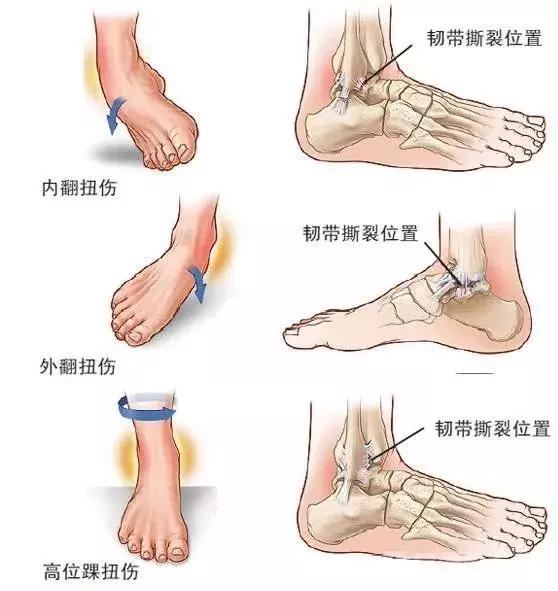 常见足球运动损伤及处理方法教案,常见的足球运动损伤的预防及治疗