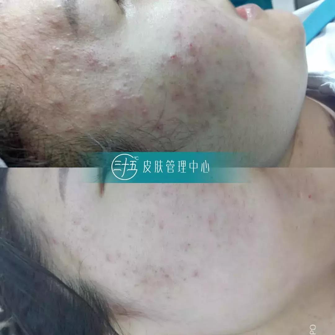 痘痘反反复复试试这招祛痘不用愁,青春期去除痘痘最有效的祛痘神器