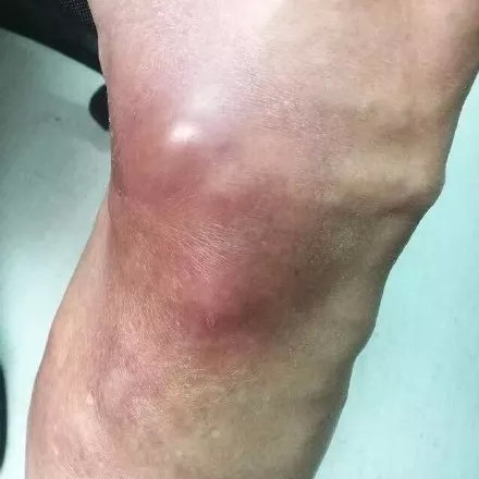 腿上的静脉曲张突然发青怎么回事,我静脉曲张脚总凉怎么办