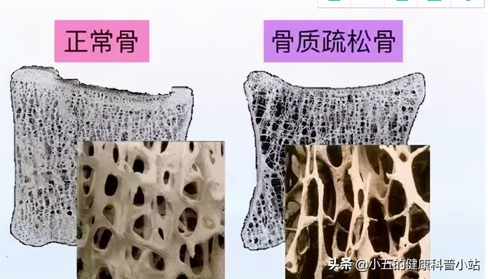 长期吃钙片怎么还是骨质疏松了呢,常年吃钙片的好与坏