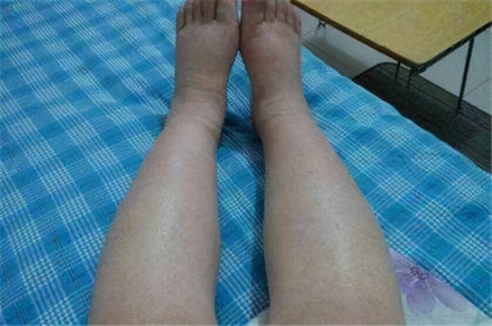 脚丫肿得很疼怎么缓解,脚丫子突然肿胀疼