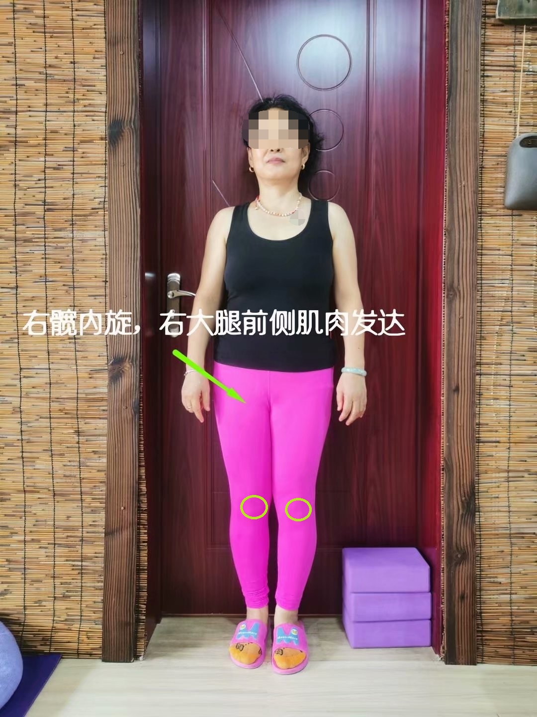 左右骨盆角度不一样,左侧骨盆比右侧骨盆突出怎么调整