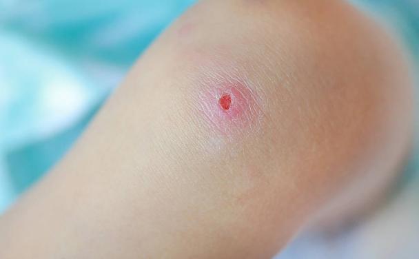 多高的血糖才引起伤口难愈合,血糖高会造成伤口愈合缓慢怎么办