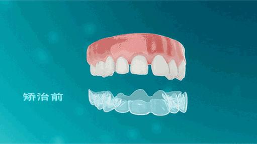 牙齿矫正最佳年龄中年,中年人龅牙可以牙齿矫正吗