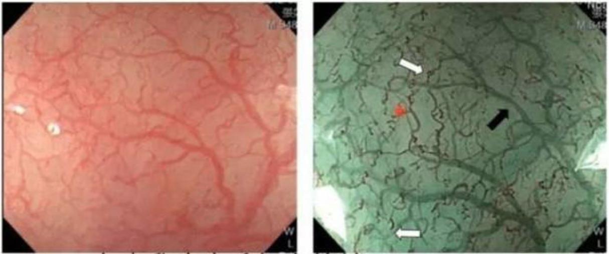 食管癌早期做胃镜能查到吗,食管癌通过胃镜可以检查出来吗