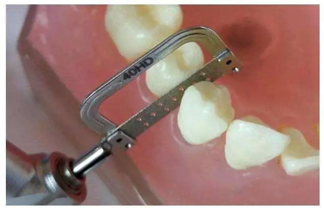 拔牙矫正的真实经历,拔牙矫正后悔的真实案例