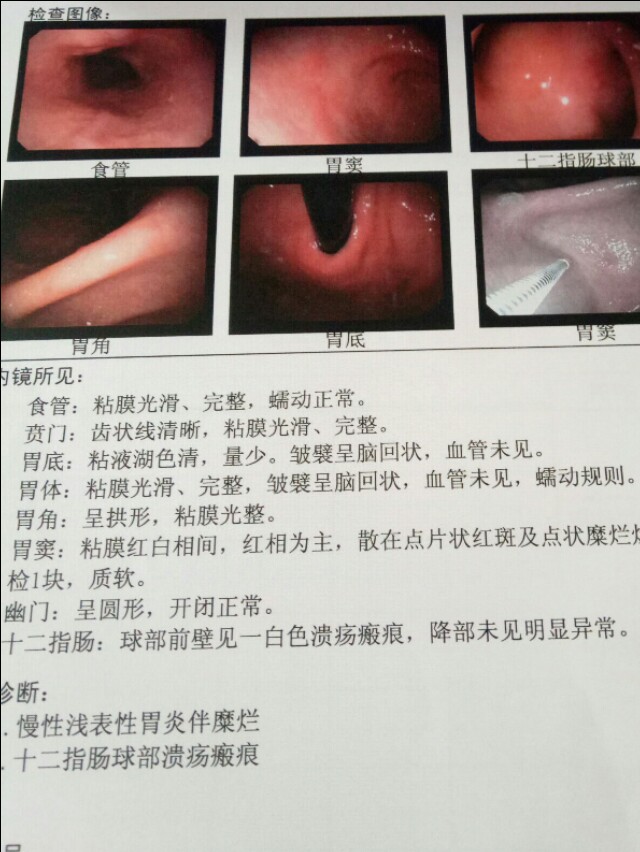 胃镜显示十二指肠溃疡疤痕,十二指肠溃疡疤痕能消除吗