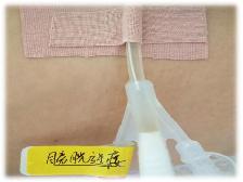 疫情期间，膀胱造瘘管居家护理怎么做？