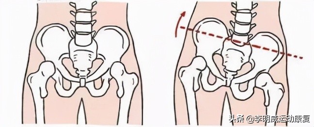 骨盆不正的危害动画视频,骨盆不正危害图片