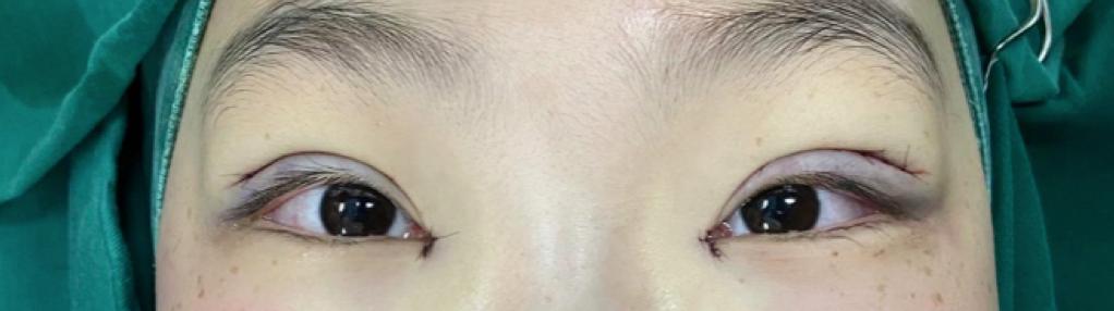 双眼皮手术详细教程,埋线双眼皮手术全过程