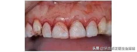 成年人露龈笑怎么矫正,如何矫正露龈笑嘴突