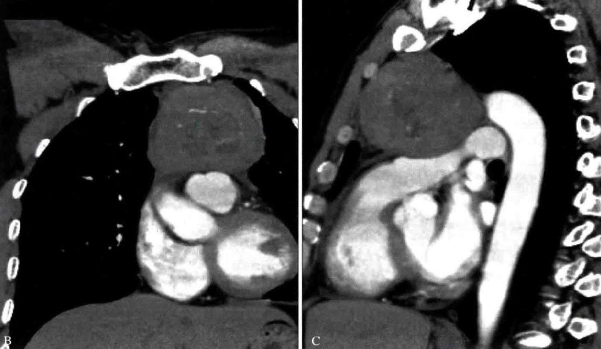 胸腺增生和纵隔肿瘤的区别和症状,纵隔胸腺肿瘤的常见临床症状表现