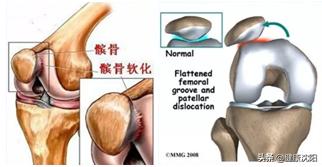 健康科普堂老年骨折的预防和治疗,健康科普堂急救法