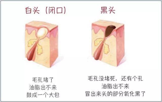 去黑头粉刺的最有效最简单的方法,你不能不知道的去粉刺秘籍