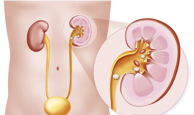 肾结石快速排石动作,肾结石7mm吃排石颗粒多久排下来