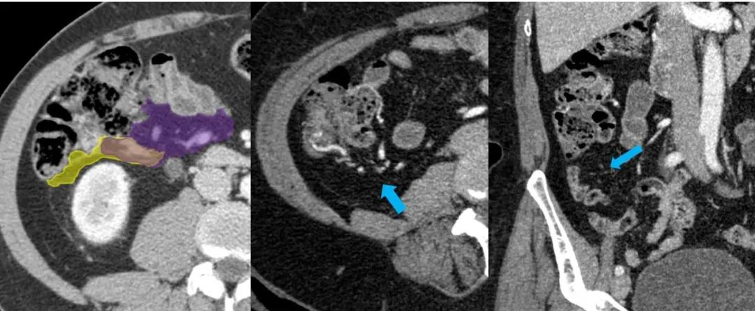 这样的解剖结构容易忘？重新认识肠系膜