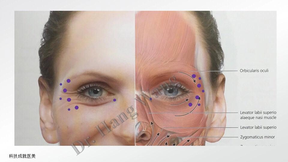 美帕肉毒精华,美帕涂抹型肉毒素怎么用