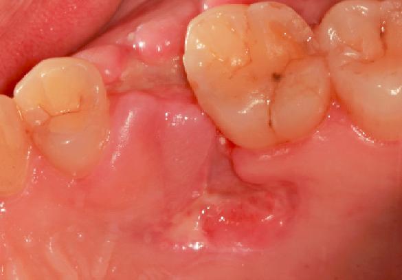 拔牙后血窟窿怎么清洁,拔牙后的血窟窿