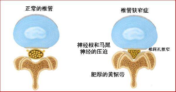 引起腰痛的常见疾病（五）“这些病也可以引起腰痛”