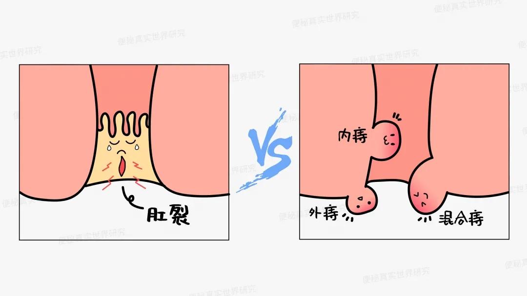 肛门瘙痒伴有肛裂是痔疮吗,肛门红肿瘙痒疼痛是痔疮吗