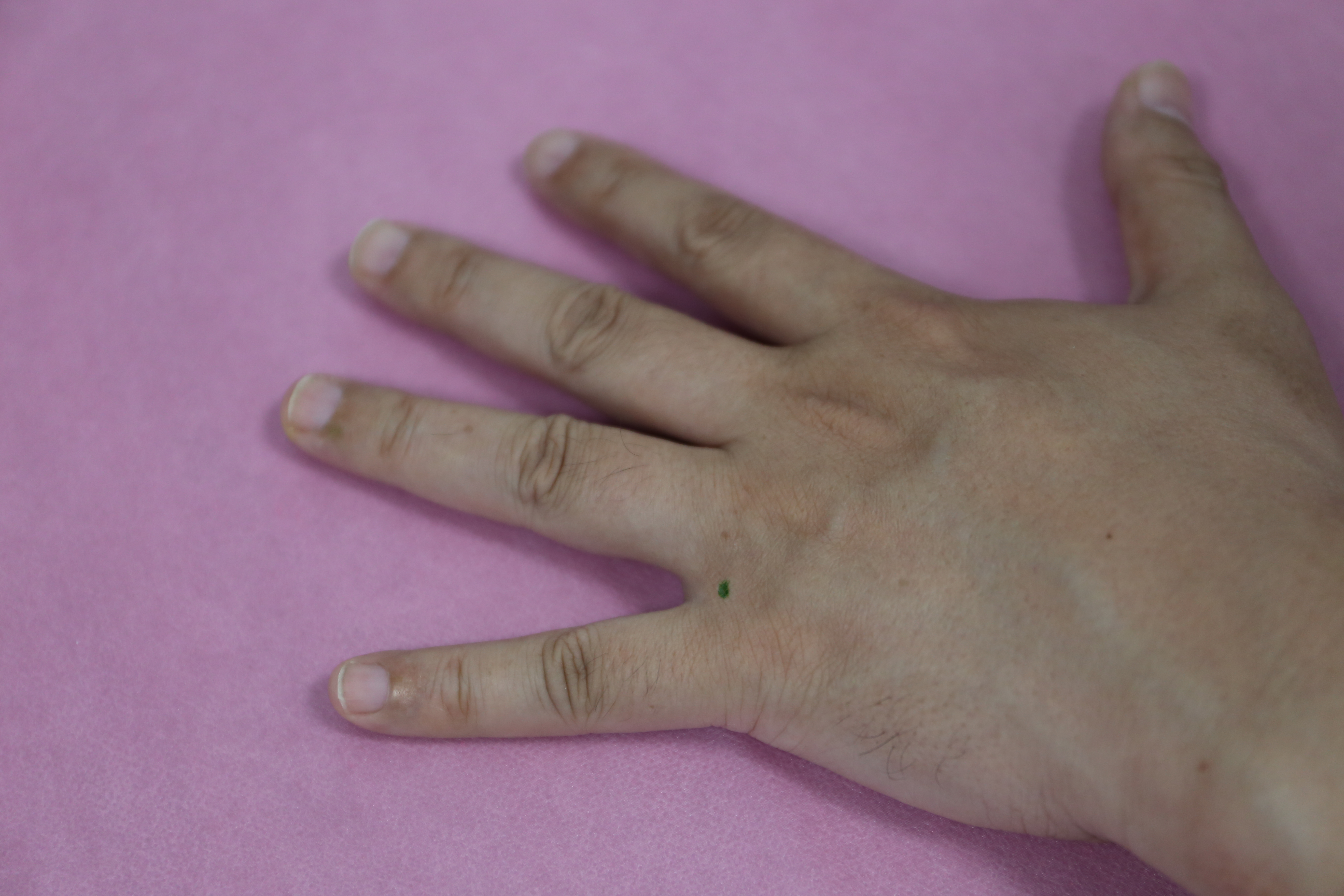 突发性耳聋轻度怎么治疗,颞下颌关节紊乱耳朵会不会聋