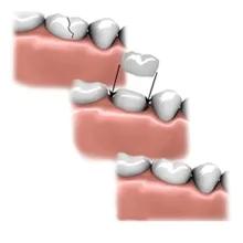 吃东西冷热交替牙受不了,冷热交替牙齿会裂开吗