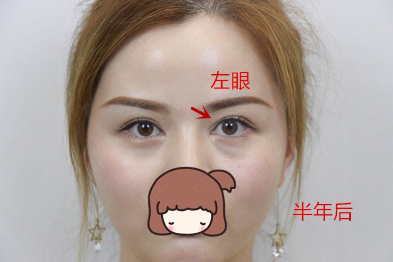 双眼皮失败了怎么修复好,双眼皮修复失败怎么解决