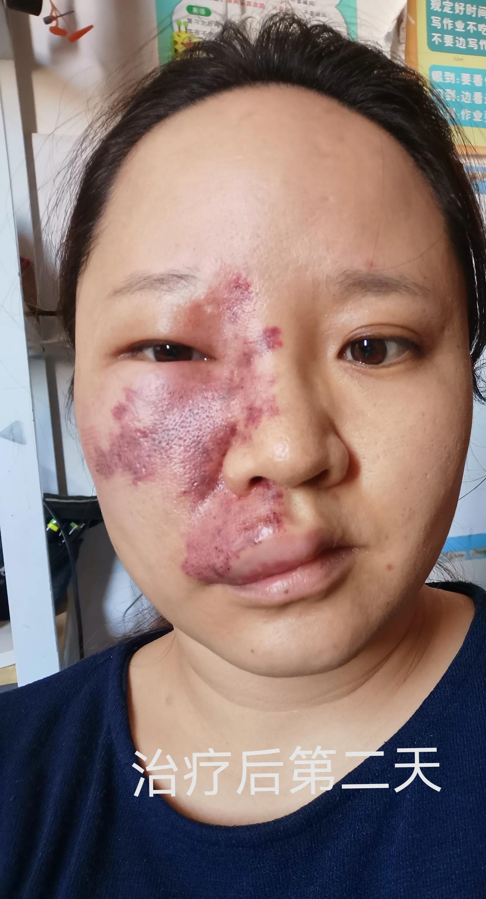 记录一下这次鲜红斑痣治疗经过