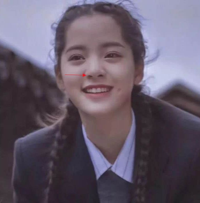 贵族手术的好处,鼻基底手术失败凹陷怎么改善