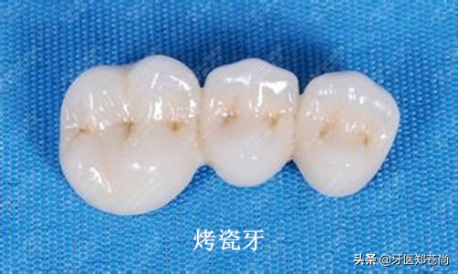 做烤瓷牙为什么要打钉在里面,门牙缺失做全瓷牙需不需要打桩