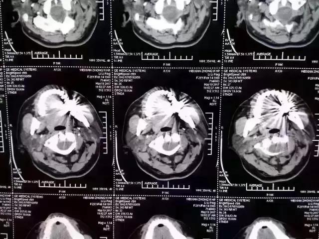 牙医用烤瓷牙冒充全瓷牙,怎么跟牙医说烤瓷牙换全瓷牙