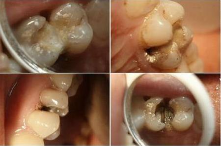 牙齿发黑发黄怎么快速去除,牙齿突然发黄发黑牙龈出血