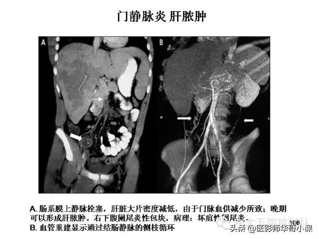 阑尾炎课件,阑尾炎的超声课件