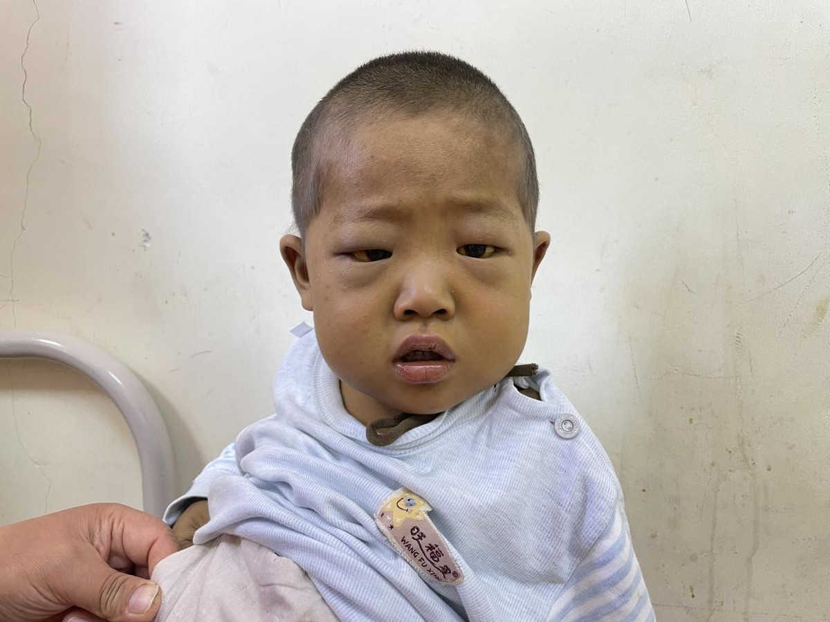 刚出生的小孩要换肝是什么病,小孩出生一星期眼睛黄