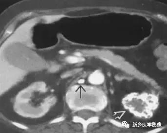 腹部平片能看到结石吗,腹部高密度结节影是什么