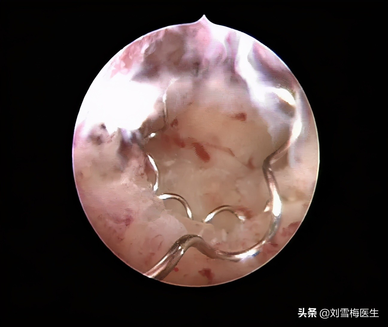 刘雪梅医生视频,刘雪梅大夫