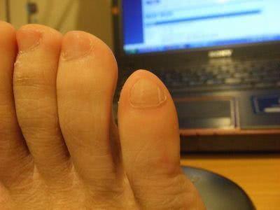 跑步出现黑趾甲,5步解决跑步黑指甲