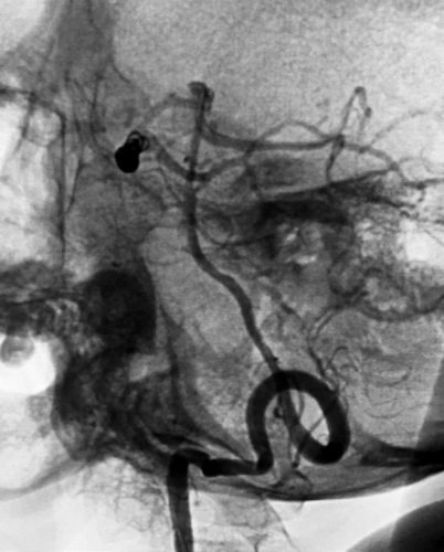 卢旺盛：脉瘤和基底动脉动脉瘤裸栓治疗术后效果非常明显