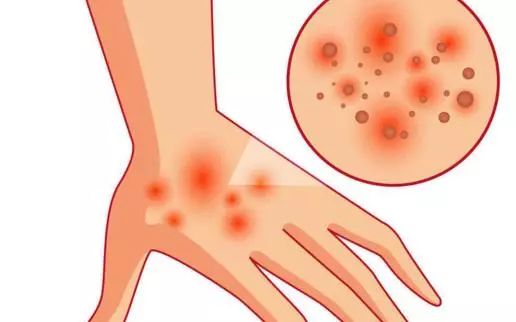 晚上湿疹瘙痒厉害怎么办用什么,孕妇湿疹晚上痒的睡不着怎么办