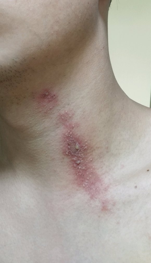 隐翅虫皮炎脓包越来越多,隐翅虫皮炎反复脱皮后有疙瘩