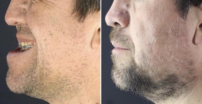 骨性地包天不做正颌手术最好方法,骨性地包天不做手术可矫正吗