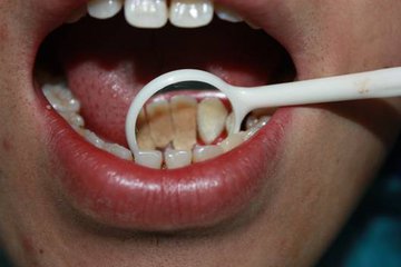 牙齿掉了有个软软的东西,牙齿上抠出黑色硬硬的东西是什么