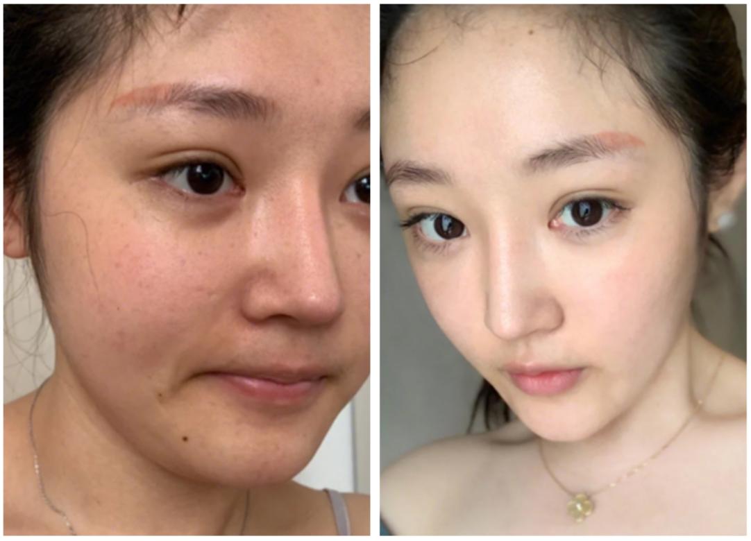 切眼袋会加速衰老的案例,割双眼皮衰老更快