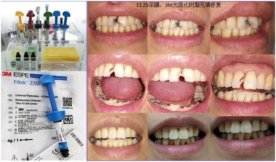 600块钱一颗牙怎么样,600块一颗牙贵吗