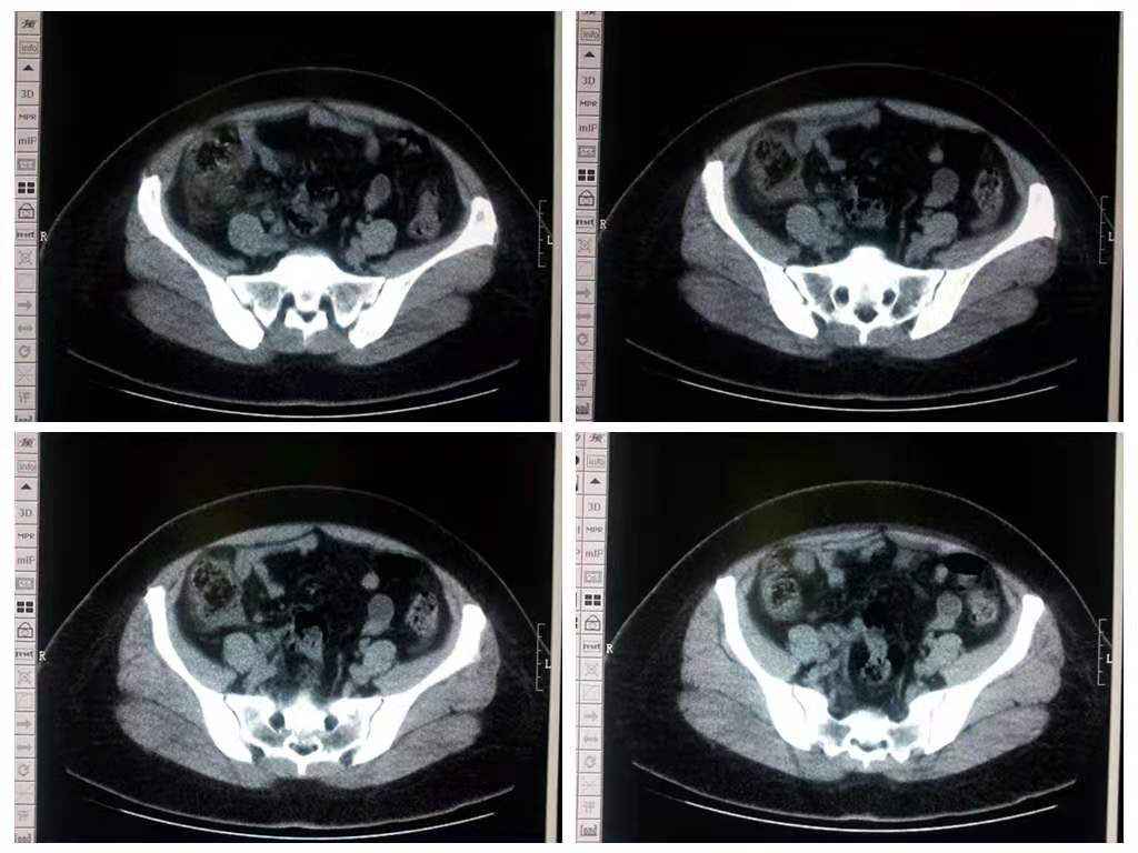 高原低氧环境下的机体的代偿反应,高原低氧导致什么病